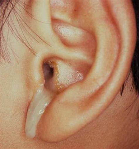 ear leaking clear fluid no pain|Fluid from the ear – causes and treatments